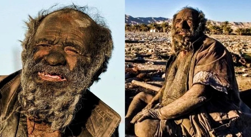 Ο πιο βρώμικος άνθρωπος στον πλανήτη έχει να κάνει μπάνιο 70 χρόνια - Τι λένε οι γιατροί! (vid)